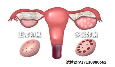 多囊卵巢综合征的七大症状，你有没有？试管助孕试试看看