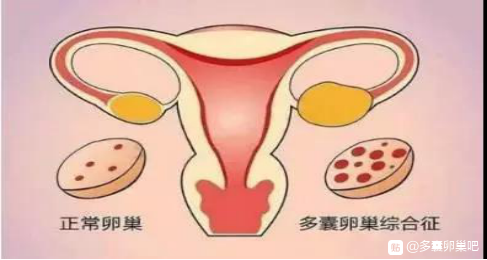 《病例科普》多囊卵巢综合征（PCOS）