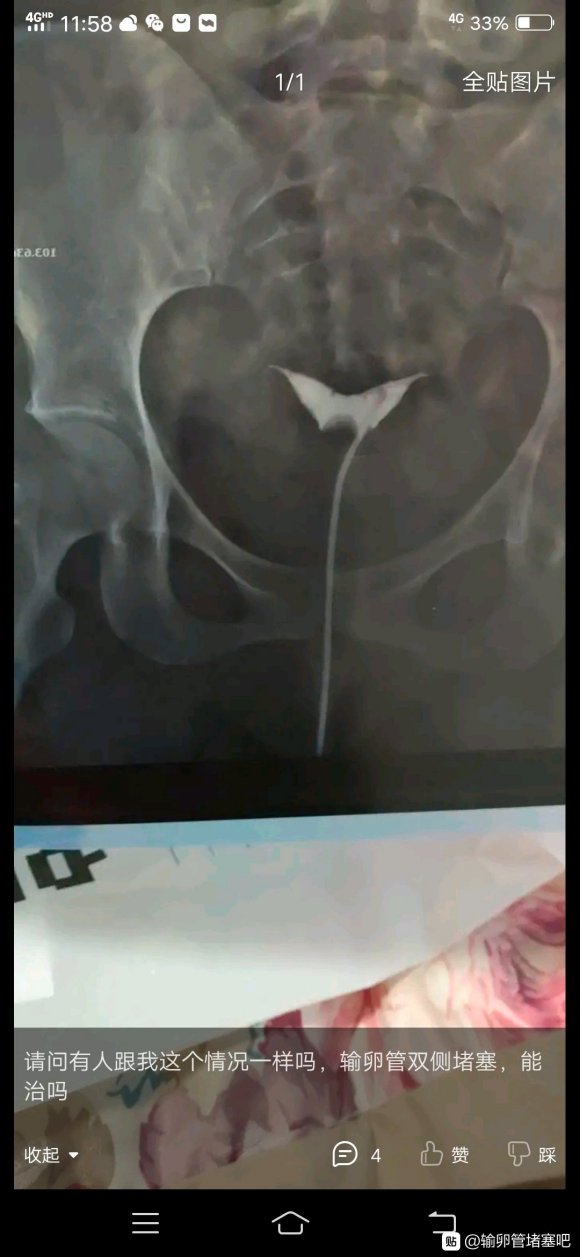 我想问问你们有没有和我一样情况的。给个招啊，要不要去做疏通手