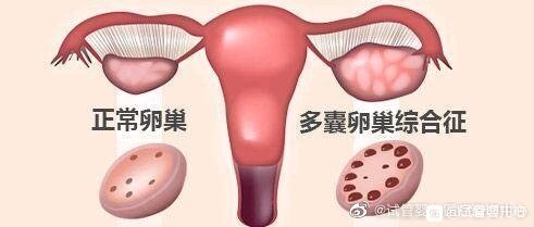 多囊卵巢综合征（PCOS）是生育年龄妇女常见的一种复杂的内分