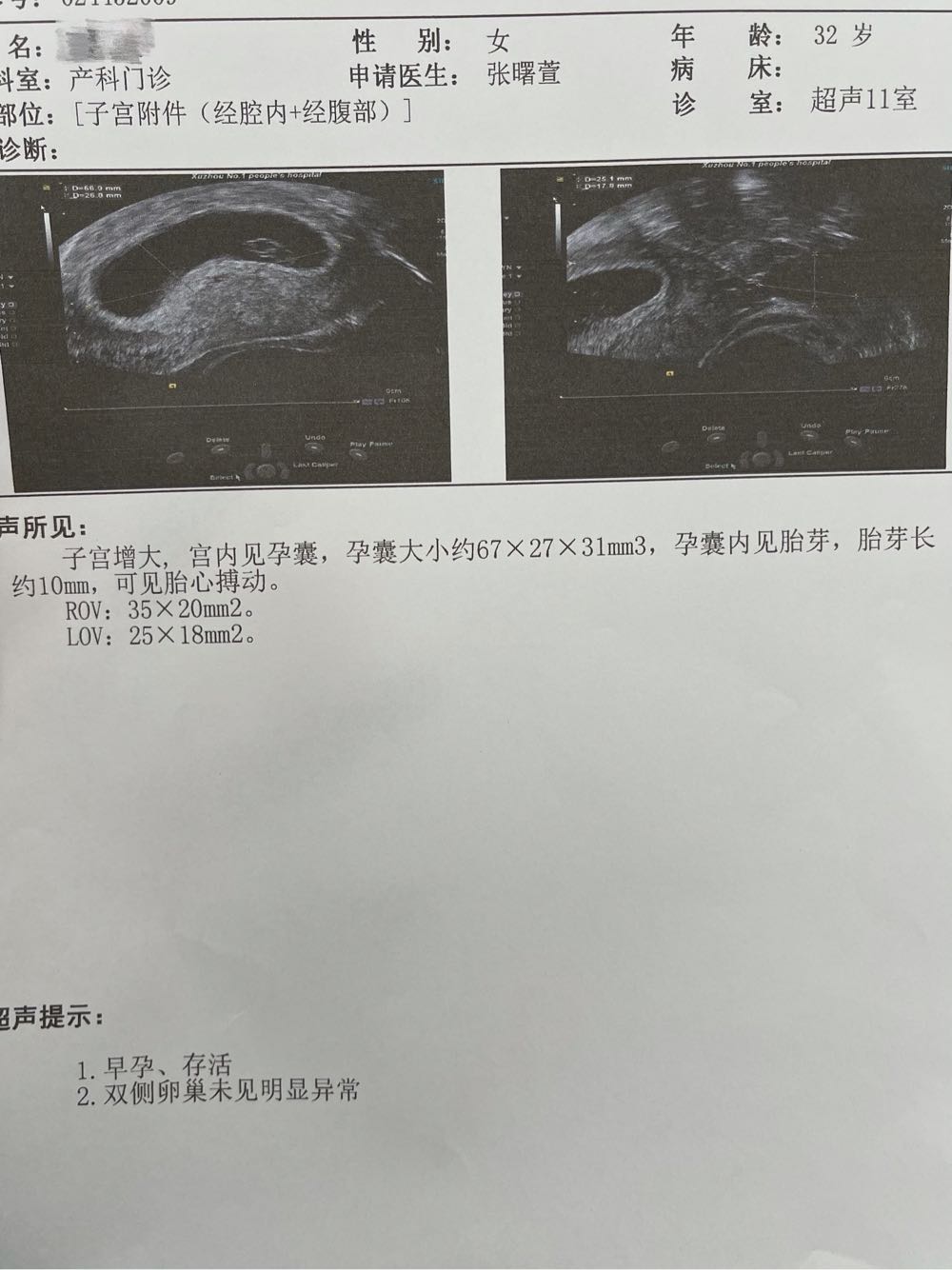 宫外孕切除一侧输卵管，隔月迎来好孕