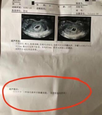 感恩！同卵双胞胎，都见胎芽胎心啦