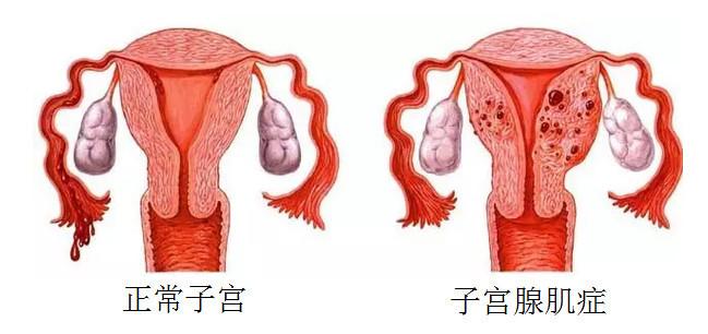 子宫腺肌症的病因