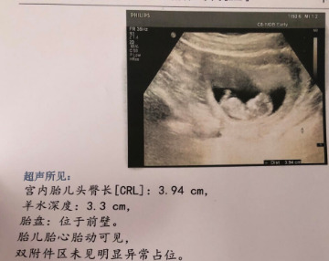 13周NT秒过，高龄孕妇