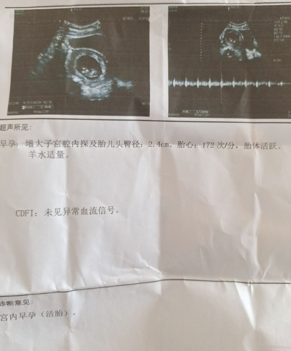 今天九周+2了，还是没忍住做了B超