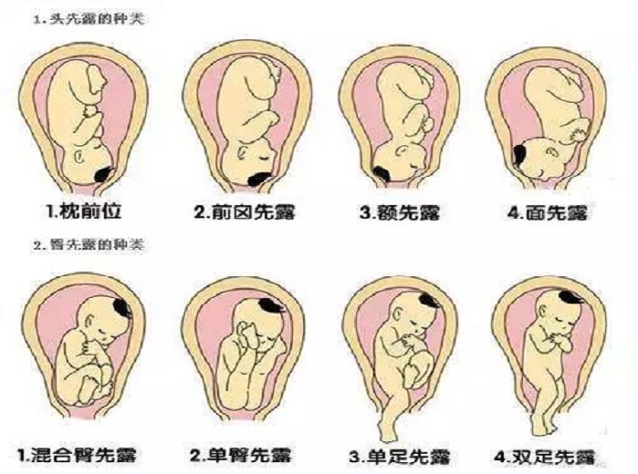 胎位与胎心位置示意图图片