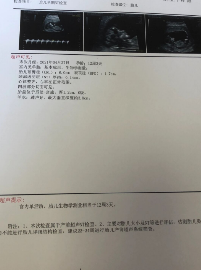 二胎宝宝来了，打了疫苗决定留，nt秒过，本来在备孕二胎