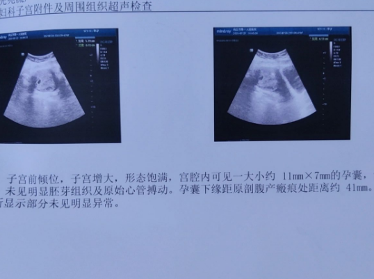 唉，备孕二胎四个月，终于怀上了