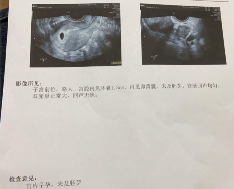 移植第19天的阴道B超，已排除宫外孕