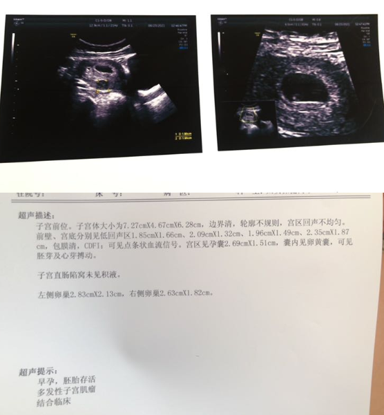 多发性子宫肌瘤纠结孩子要不要？