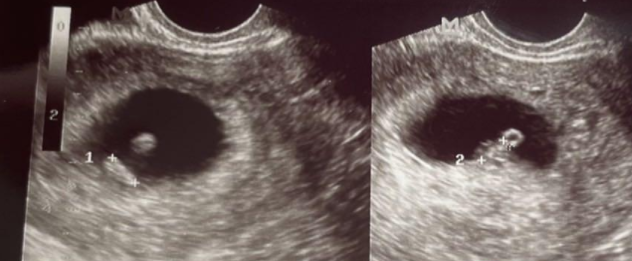 双胎胎芽胎心都有啦，两个胚胎发育都很好