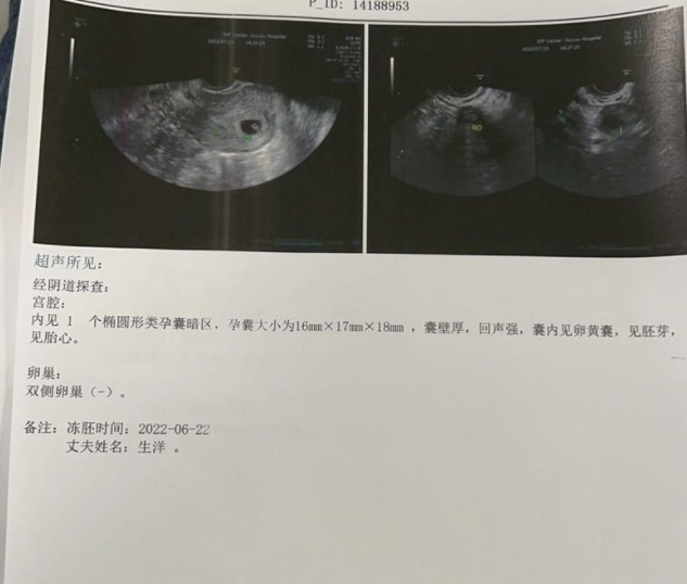 移植28天B超检查，已见胎心胎芽，一直都有褐色分泌物