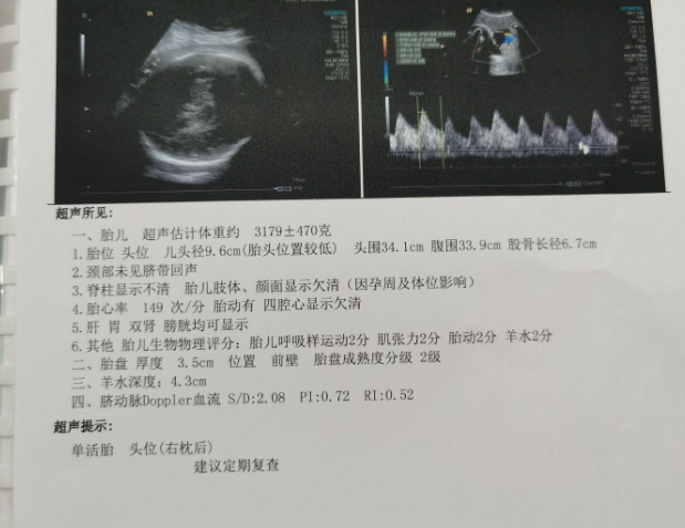 今天做了B超，宝宝的头很大