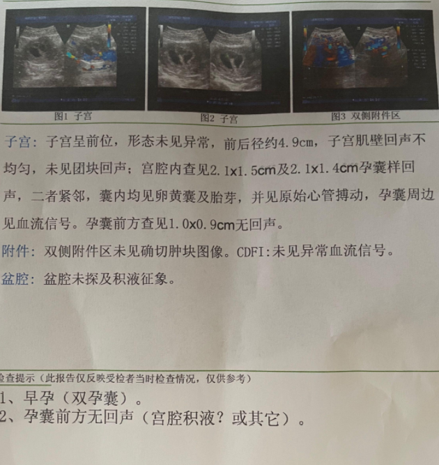 11月17号移植，双孕囊，已有胎心胎芽