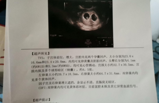 鲜胚移植确定怀孕啦，去做了一超的检查