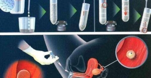 什么是试管胚胎移植技术