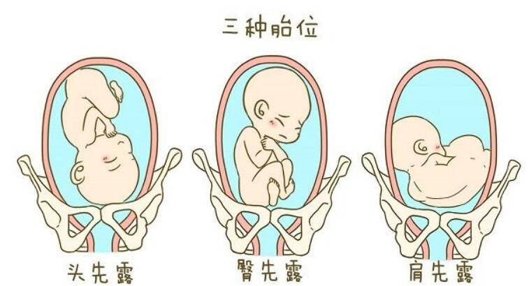 臀部朝向女性头部,呈现一个倒立的姿态,臀位则与之相反,是宝宝臀部